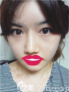 在韓國(guó)德萊茵做面部輪廓+眼鼻整形后6周 在韓國(guó)德萊茵做面部輪廓+眼鼻整形后6周