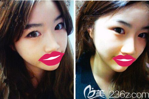 在韓國(guó)德萊茵做面部輪廓+眼鼻整形后4個(gè)月 在韓國(guó)德萊茵做面部輪廓+眼鼻整形后4個(gè)月