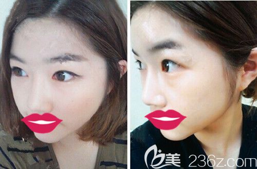 朋友都說我在韓國(guó)德萊茵做的Vline+眼鼻整形后1年的效果非常自然