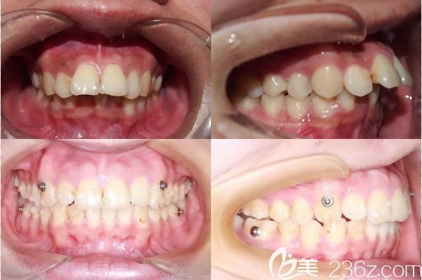 廈門登特口腔袁煒靈醫(yī)師隱形正畸效果對比圖 廈門登特口腔袁煒靈醫(yī)師隱形正畸效果對比圖
