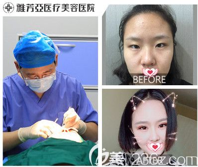 石家莊雅芳亞4月春季整形進行時 激光祛斑和雙眼皮的優(yōu)惠價格為1980元