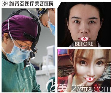 雅芳亞整形醫(yī)院做自體軟骨隆鼻案例
