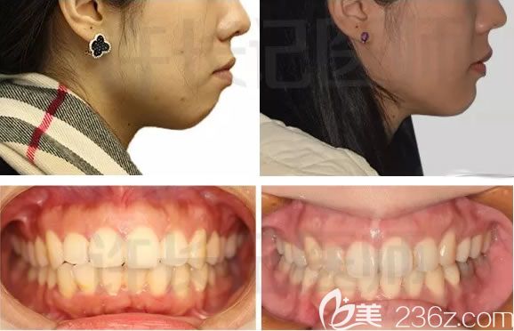 許長記醫(yī)生成人齙牙矯正臉型變化對比圖 許長記醫(yī)生成人齙牙矯正臉型變化對比圖