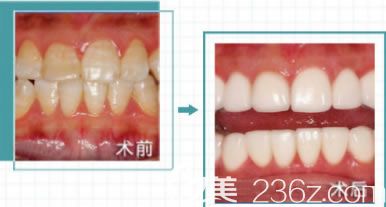 福州維樂口腔醫(yī)院林錦醫(yī)生牙齒美白案例