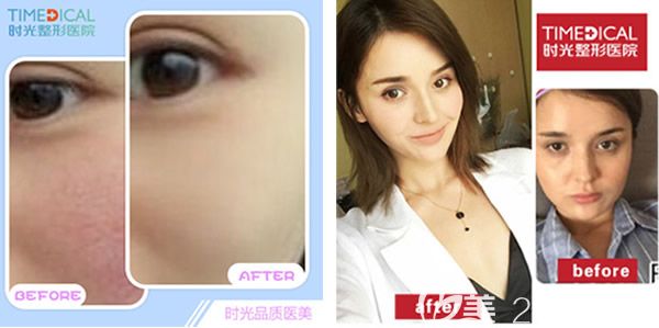蘭州時(shí)光整形醫(yī)院激光去紅血絲+注射瘦臉效果案例