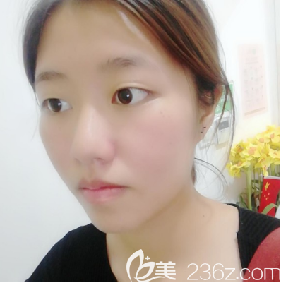 廣州紫馨雙眼皮術(shù)前照片 廣州紫馨雙眼皮術(shù)前照片