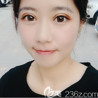 廣州紫馨李石峰雙眼皮案例術(shù)后10天 廣州紫馨李石峰雙眼皮案例術(shù)后10天