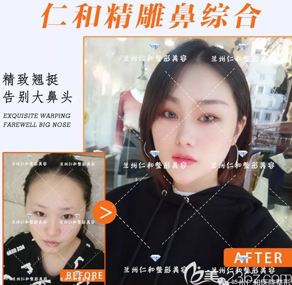 蘭州仁和整形陶宏偉硅膠隆鼻+自體肋軟骨綜合隆鼻案例