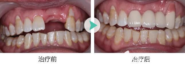 鄭州拜博口腔王咲予院長單顆種植牙效果圖