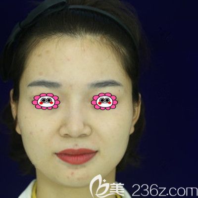 做全面部脂肪填充前的照片 做全面部脂肪填充前的照片