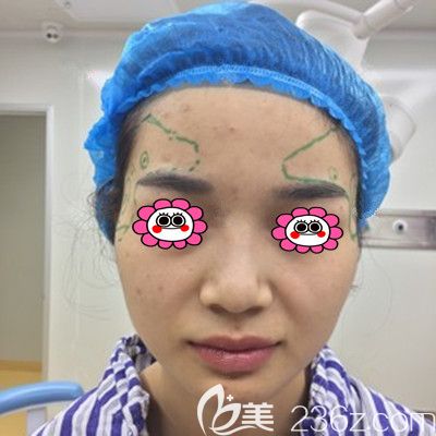 面部脂肪填充手術(shù)當(dāng)天 面部脂肪填充手術(shù)當(dāng)天