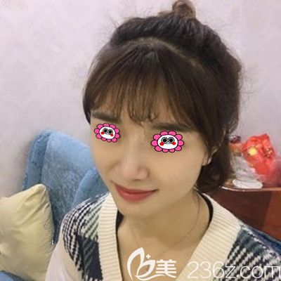 全臉脂肪填充第7天照片 全臉脂肪填充第7天照片