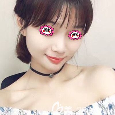 面部脂肪填充30天恢復(fù)照片效果 面部脂肪填充30天恢復(fù)照片效果