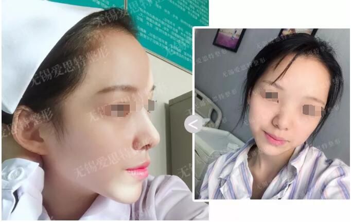 歐陽黎平分享鼻綜合術后15天恢復效果 歐陽黎平分享鼻綜合術后15天恢復效果