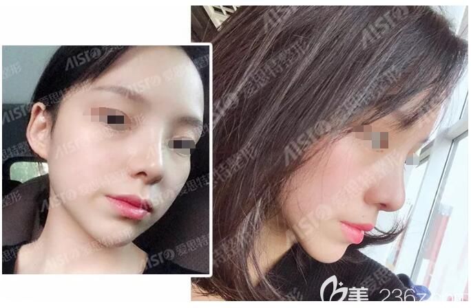 幸運(yùn)的趕上無(wú)錫愛(ài)思特征集鼻整形案例 別人花5萬(wàn)元的鼻綜合我只花了0元還是歐陽(yáng)黎平和郭曄醫(yī)生聯(lián)合坐診