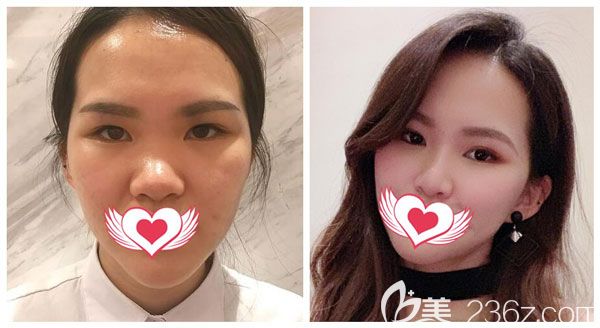 金輝做鼻綜合+耳軟骨墊鼻尖案例效果