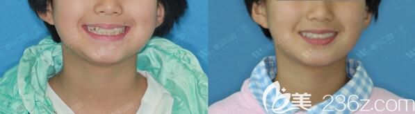 青島維樂(lè)口腔隱形牙齒矯正<span style=