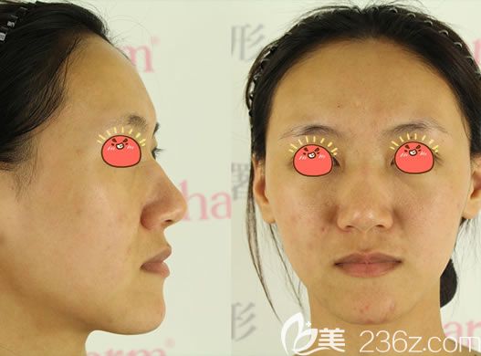 嘉興曙光醫(yī)院注射玻尿酸填充前 嘉興曙光醫(yī)院注射玻尿酸填充前