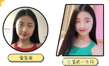 宋麗秋祛斑暗沉對比照 宋麗秋祛斑暗沉對比照