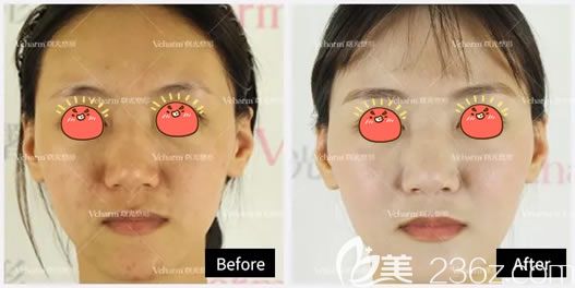 嘉興曙光玻尿酸填充<span style= 嘉興曙光玻尿酸填充<span style=