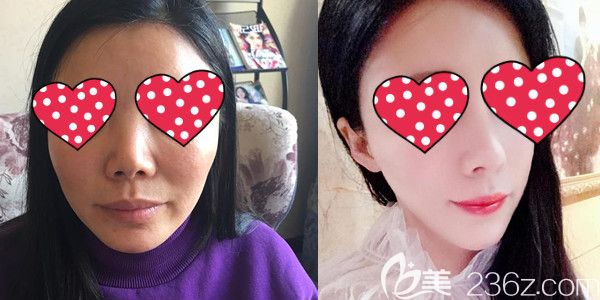 西寧時光醫(yī)生硅膠假體墊鼻梁+自體肋軟骨墊鼻尖綜合隆鼻效果圖 西寧時光醫(yī)生硅膠假體墊鼻梁+自體肋軟骨墊鼻尖綜合隆鼻效果圖