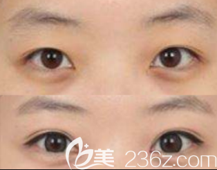 韓國BBC成政燁院長雙眼皮案例效果對(duì)比圖 韓國BBC成政燁院長雙眼皮案例效果對(duì)比圖