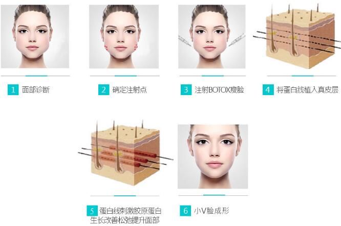 無(wú)錫愛(ài)思特小V臉提升術(shù)操作流程