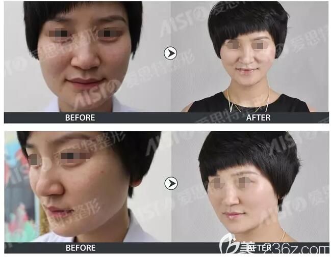 無(wú)錫愛(ài)思特get自拍上鏡小V臉僅一招：小V臉提升術(shù)=+玻尿酸+膠原蛋白線(xiàn)性提拉 快來(lái)圍觀術(shù)后效果