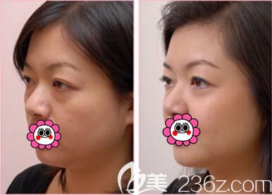 沈陽百嘉麗整形美容醫(yī)院祛眼袋真人對比