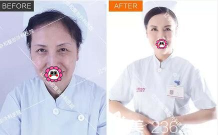 沈陽<!--<i data=20240703-sp></i>-->整形外科醫(yī)院祛眼袋真人前后對比