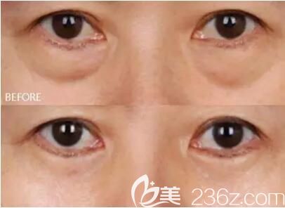 沈陽名流整形美容醫(yī)院祛眼袋真人前后對比