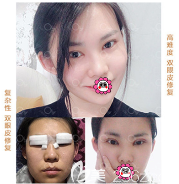 <!--<i data=20240703-sp></i>--><!--<i data=20240703-sp></i>-->眼修復(fù)案例