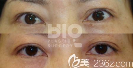 韓國辛容鎬雙眼皮修復案例