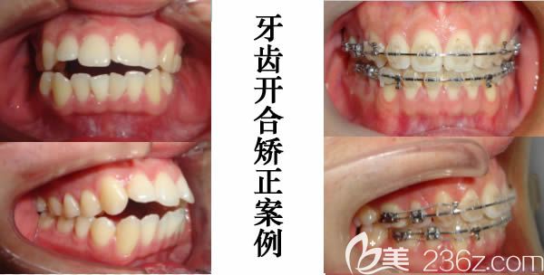 莫媛媛醫(yī)生牙齒開合矯正前后對(duì)比效果圖 莫媛媛醫(yī)生牙齒開合矯正前后對(duì)比效果圖