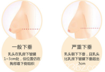 乳房下垂矯正示意圖
