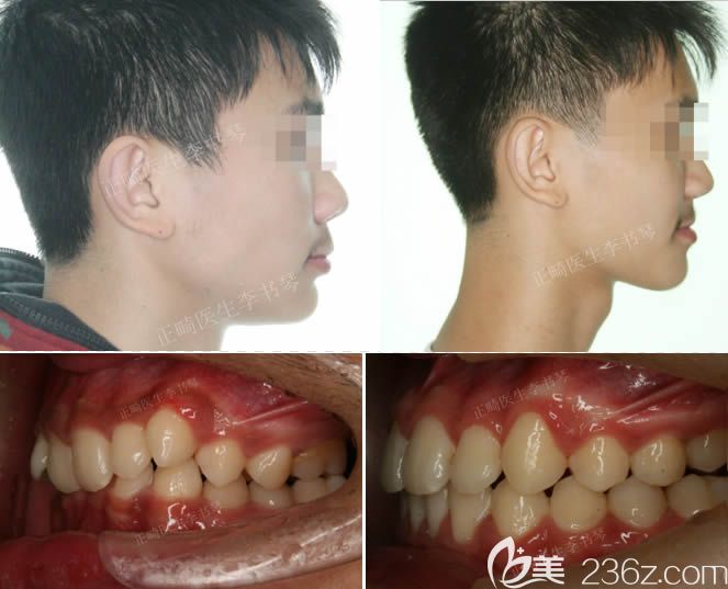 重慶維樂李書琴醫(yī)生13歲青少年內(nèi)傾性深覆合矯正后臉型變化 重慶維樂李書琴醫(yī)生13歲青少年內(nèi)傾性深覆合矯正后臉型變化