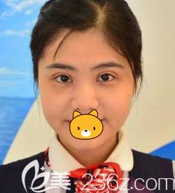 哈爾濱瑞麗注射瘦臉前 哈爾濱瑞麗注射瘦臉前