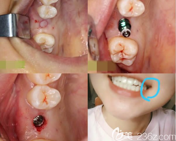廈門登特口腔盧偉院長種植牙效果圖
