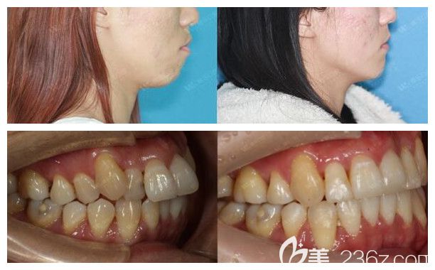 青島維樂口腔隱形矯正前后對比圖 青島維樂口腔隱形矯正前后對比圖