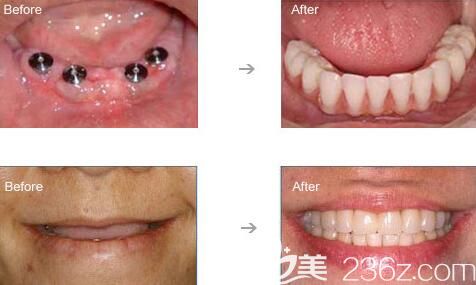 青島維樂口腔全口種植牙案例效果 青島維樂口腔全口種植牙案例效果