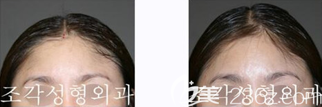 韓國(guó)雕刻整形醫(yī)院宋龍?zhí)┕撬嗵畛漕^頂案例效果對(duì)比圖