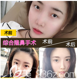 深圳德漾整形醫(yī)院雙眼皮案例 深圳德漾整形醫(yī)院雙眼皮案例