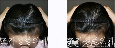 韓國(guó)雕刻整形外科醫(yī)院骨水泥填充后腦勺案例效果對(duì)比圖
