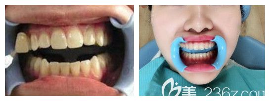 維樂口腔牙齒冷光美白效果 維樂口腔牙齒冷光美白效果
