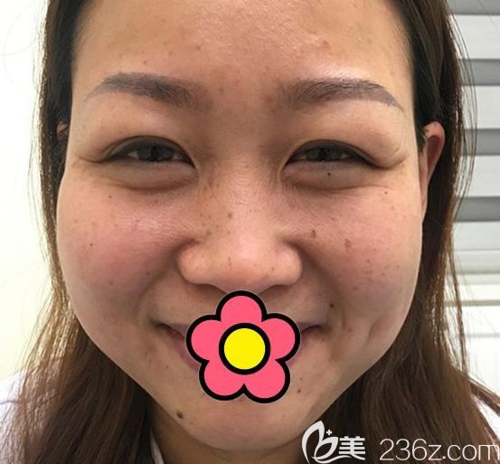 蘭州韓美整形陳誠主任做皮秒激光祛斑前 蘭州韓美整形陳誠主任做皮秒激光祛斑前