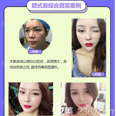 深圳德漾梁志生鼻綜合隆鼻手術(shù)案例圖 深圳德漾梁志生鼻綜合隆鼻手術(shù)案例圖