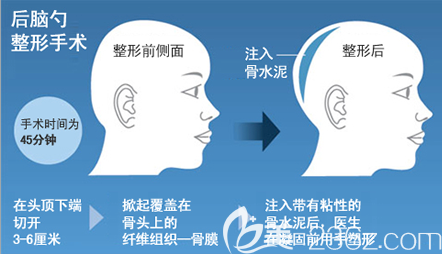 骨水泥后腦勺填充手術(shù)示意圖