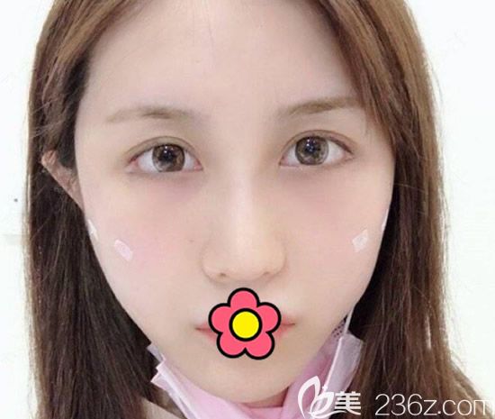 蘭州韓美面部線(xiàn)雕第3天效果 蘭州韓美面部線(xiàn)雕第3天效果