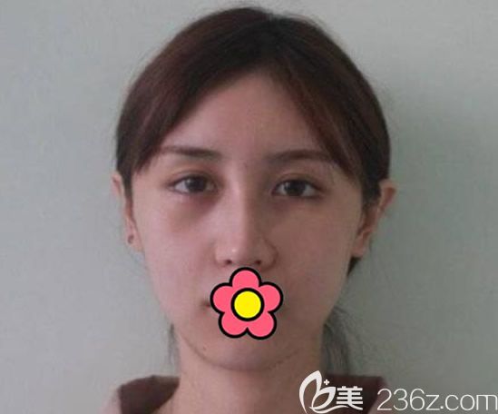 蘭州韓美整形醫(yī)院找面部埋線(xiàn)提升前 蘭州韓美整形醫(yī)院找面部埋線(xiàn)提升前