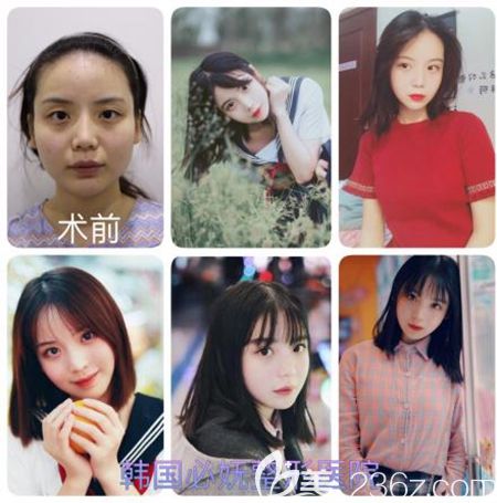 韓國必嫵面部輪廓五件套手術(shù)案例 韓國必嫵面部輪廓五件套手術(shù)案例